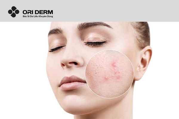 Đặc điểm của mụn ẩn