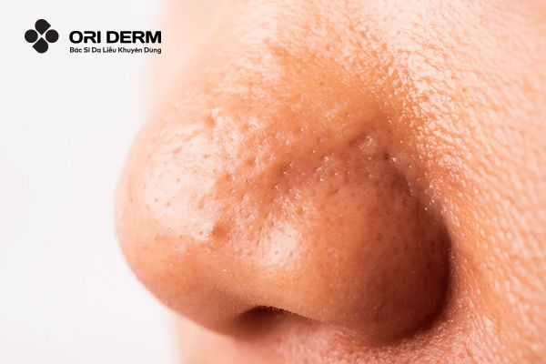 Tìm Hiểu Nguyên Nhân Và Cách Trị Mụn Ẩn Ở Mũi Tại Nhà