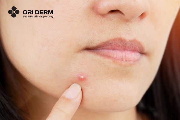 Mụn mủ là gì? Các dấu hiệu thường gặp