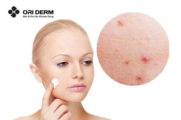 Cách sử dụng thuốc trị mụn trứng cá để đạt hiệu quả tốt nhất