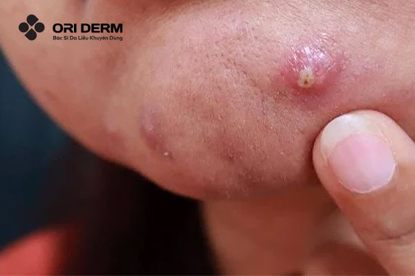 Mụn bọc là gì? Các dạng mụn bọc phổ biến