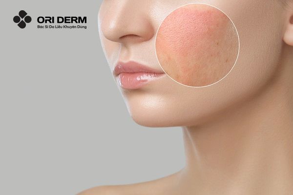 4 nguyên nhân gây dị ứng mỹ phẩm trên mặt