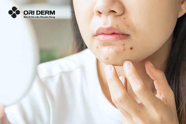 Nguyên Nhân, Phương Pháp Điều Trị Và Ngăn Ngừa Mụn Mọc Ở Cằm Hiệu Quả