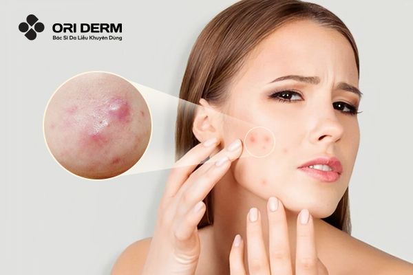 Mụn Viêm Không Nhân: Nguyên Nhân Và Cách Xử Lý Hiệu Quả