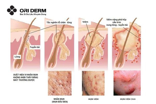 Mụn viêm bị chai hình thành như thế nào?