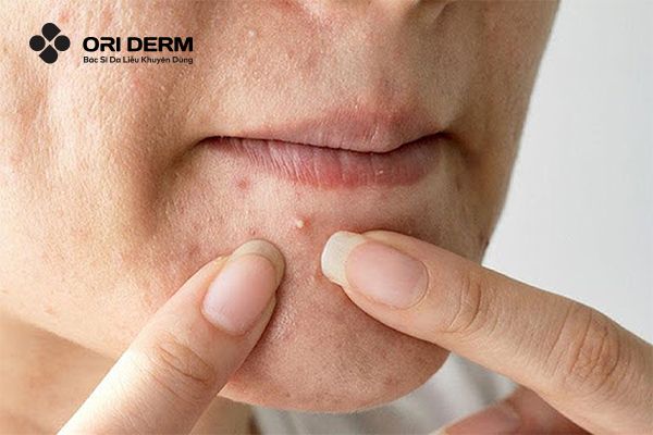 Thời điểm an toàn để nặn mụn ẩn