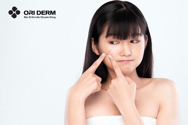 Có nên tự nặn mụn trên mặt tại nhà không?