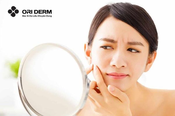 Mụn Ẩn Có Nên Nặn Không? Cách Nặn Mụn ẩn Chuẩn Y Khoa