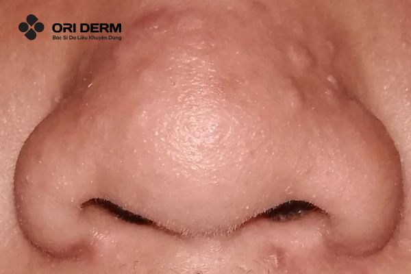 Nguyên nhân gây mụn ẩn ở mũi