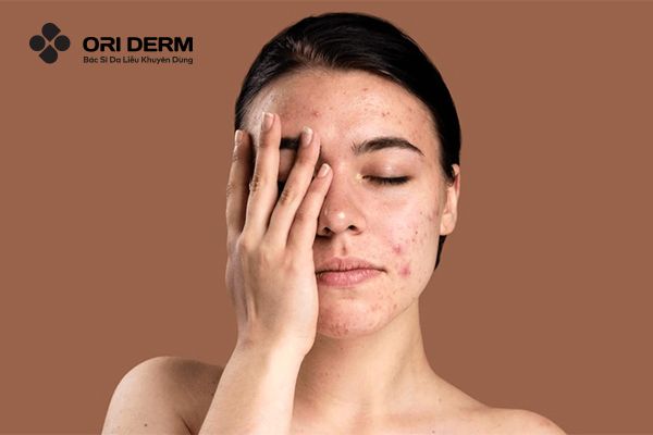 Nguyên nhân gây mụn nội tiết