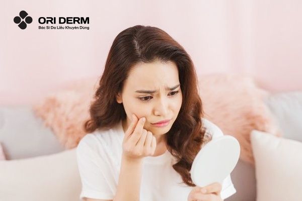 Nguyên nhân gây sẹo mụn