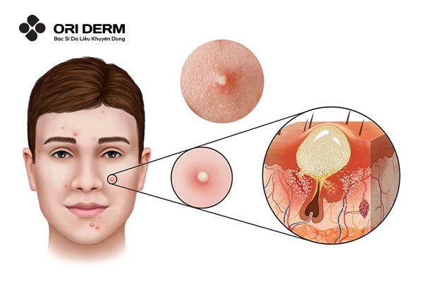 Nguyên nhân hình thành mụn bọc