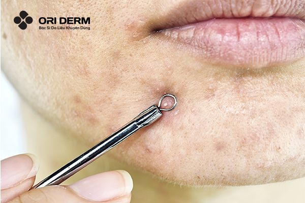 Nguyên nhân hình thành thâm sau mụn