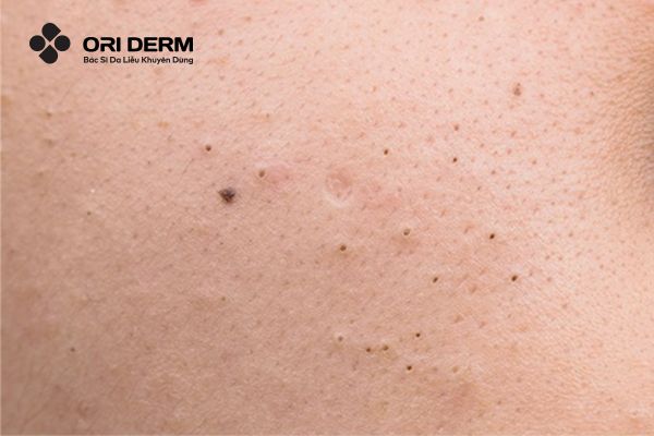 Nguyên nhân gây mụn đầu đen là gì?