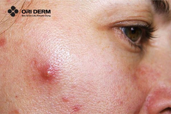 Nhận biết mụn viêm chai?