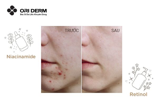 Có nên kết hợp Niacinamide và Retinol không?
