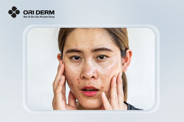 Đặc điểm của da dầu mụn