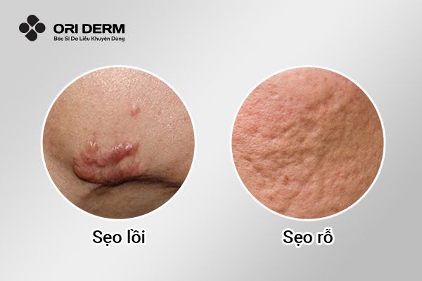 Sẹo mụn là gì? Có mấy loại phổ biến?