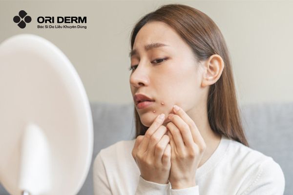 Điều trị sớm khi phát hiện các dấu hiệu của mụn