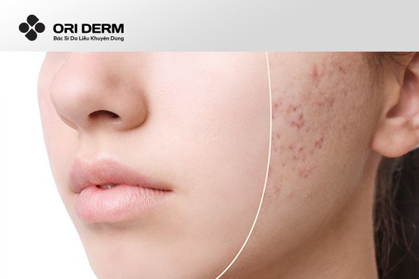 Công dụng của thuốc trị mụn ẩn