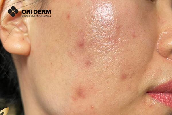 Peel da trị thâm là gì?