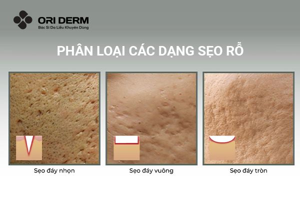 Phân loại các dạng sẹo rỗ