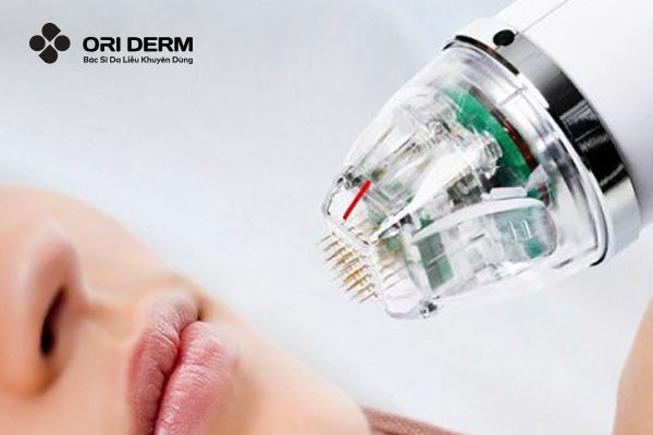 RF Microneedling (Lăn Kim RF)