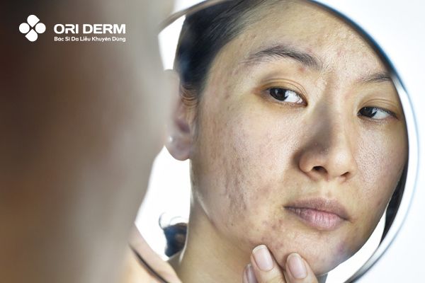 Sẹo đáy tròn có tự đầy được không?