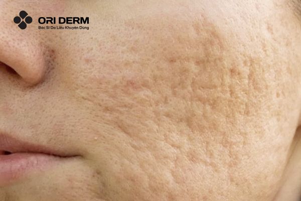 Sẹo đáy tròn là gì?