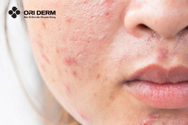 Vậy sẹo mụn có tự hết không?