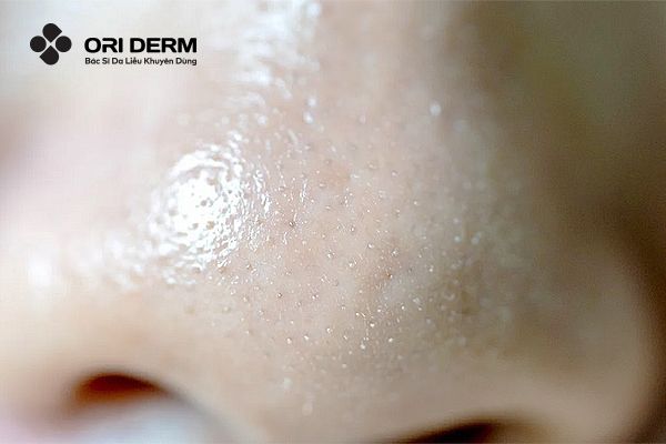 Sợi bã nhờn và các dấu hiệu nhận biết