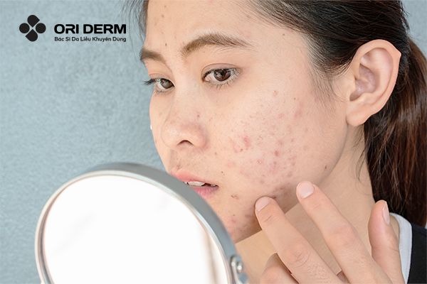 Tác hại của sợi bã nhờn gây ra