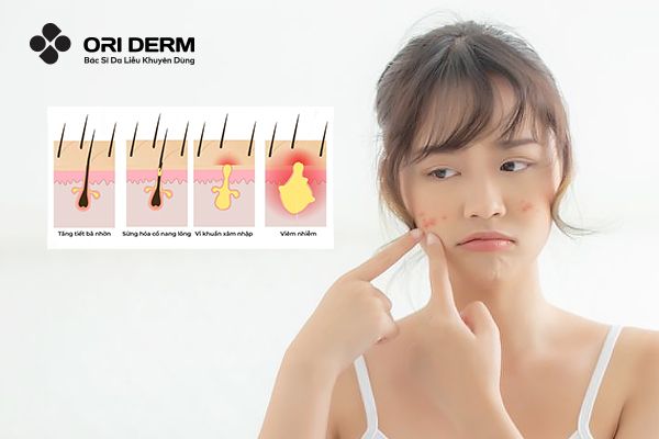 Những Lý Do Khiến Mụn Viêm Tái Đi Tái Lại Mà Bạn Không Ngờ Tới