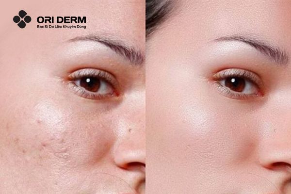 Tẩy tế bào chết cho da