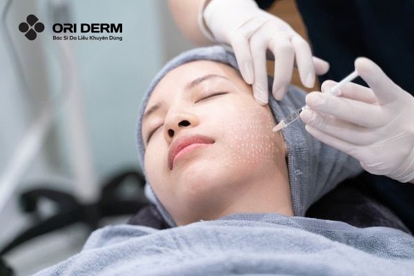 Tiêm meso làm đầy sẹo rỗ đáy tròn