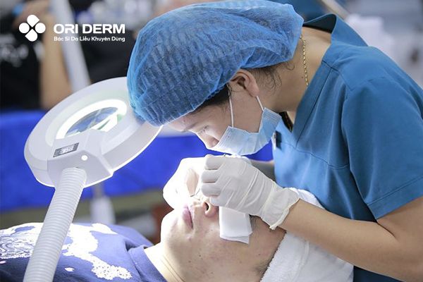 Tiểu phẫu để loại bỏ nhân mụn