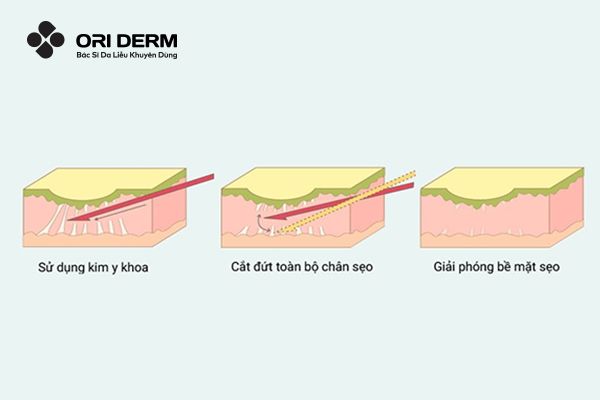 tìm hiểu về cắt đáy sẹo