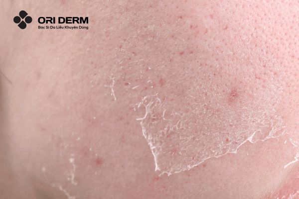 Tình trạng da sau khi Laser CO2