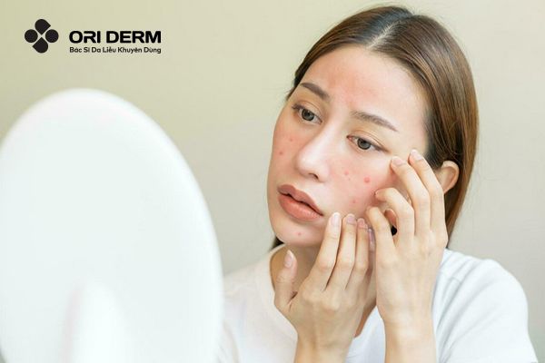 Bị Mụn Viêm Đỏ Ngứa Nên Xử Lý Như Thế Nào Cho Hiệu Quả?