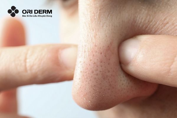 Dấu hiệu nhận biết mụn đầu đen ở mũi