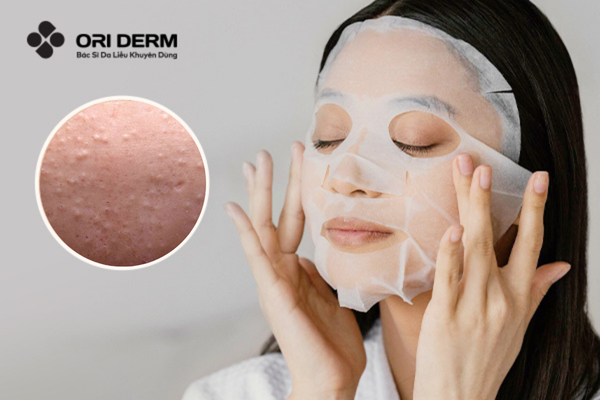 Da dầu mụn nhạy cảm có nên dùng kem chống nắng không?