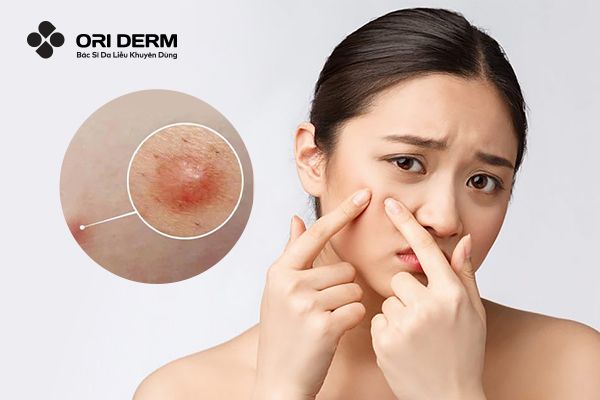 Mụn Viêm Bị Chai: Tìm Hiểu Nguyên Nhân Và Cách Điều Trị Chuẩn Y Khoa