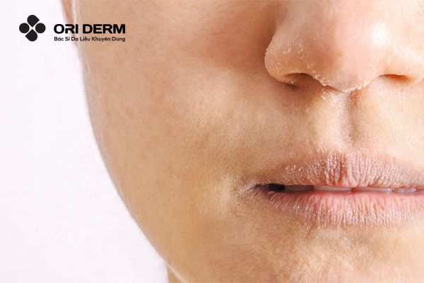 Vì sao da khô nên đắp mặt nạ?