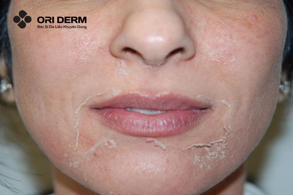 Vì sao sau khi peel da bị thâm?