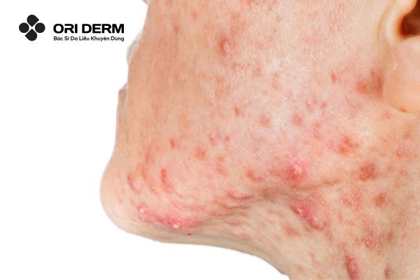 Mụn viêm là gì? Vì sao bị mụn viêm?