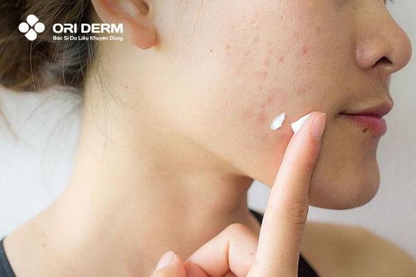 Vậy đắp mặt nạ xong có nên bôi kem trị mụn không?