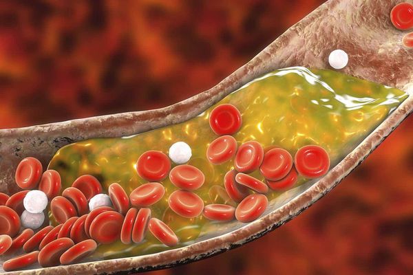 Ăn socola giúp giảm cholesterol