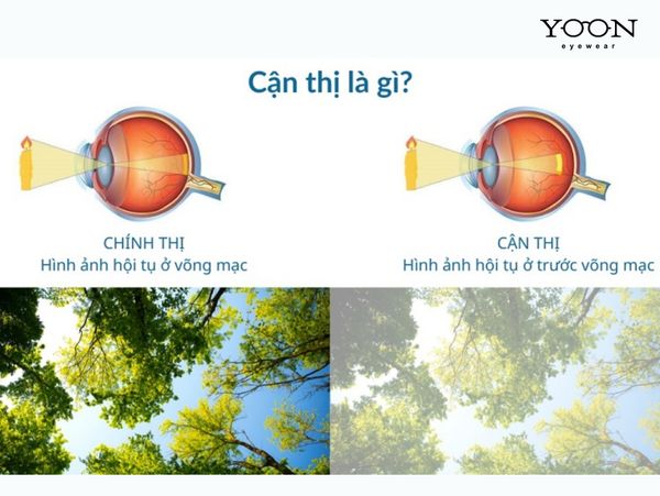 CẬN THỊ LÀ GÌ?