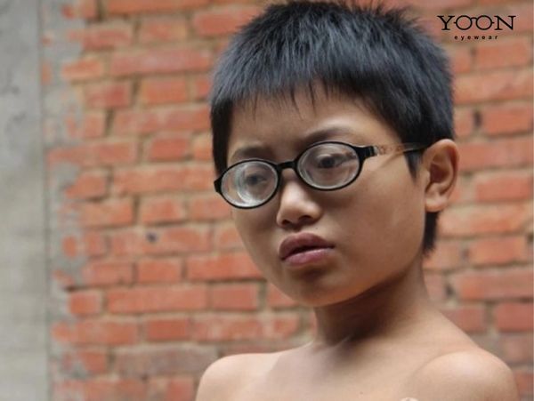 CẬN THỊ NẶNG LÀ GÌ?