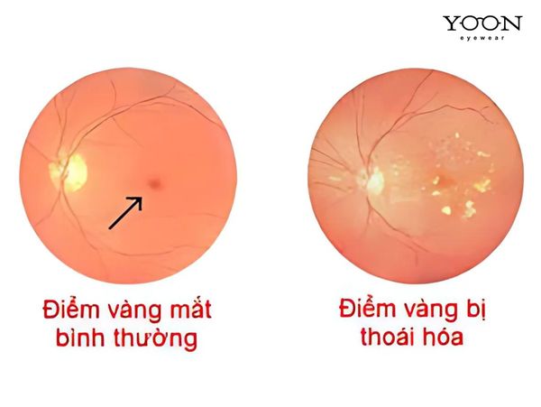 THOÁI HÓA ĐIỂM VÀNG LÀ GÌ? TRIỆU CHỨNG?